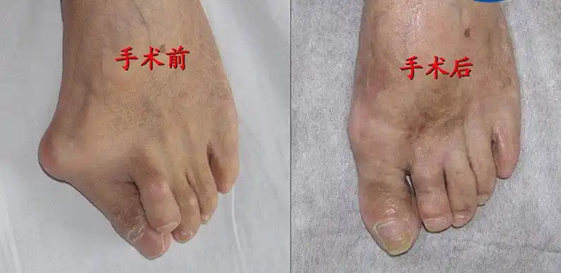 专家为您解析足拇外翻(大脚骨病)的治疗