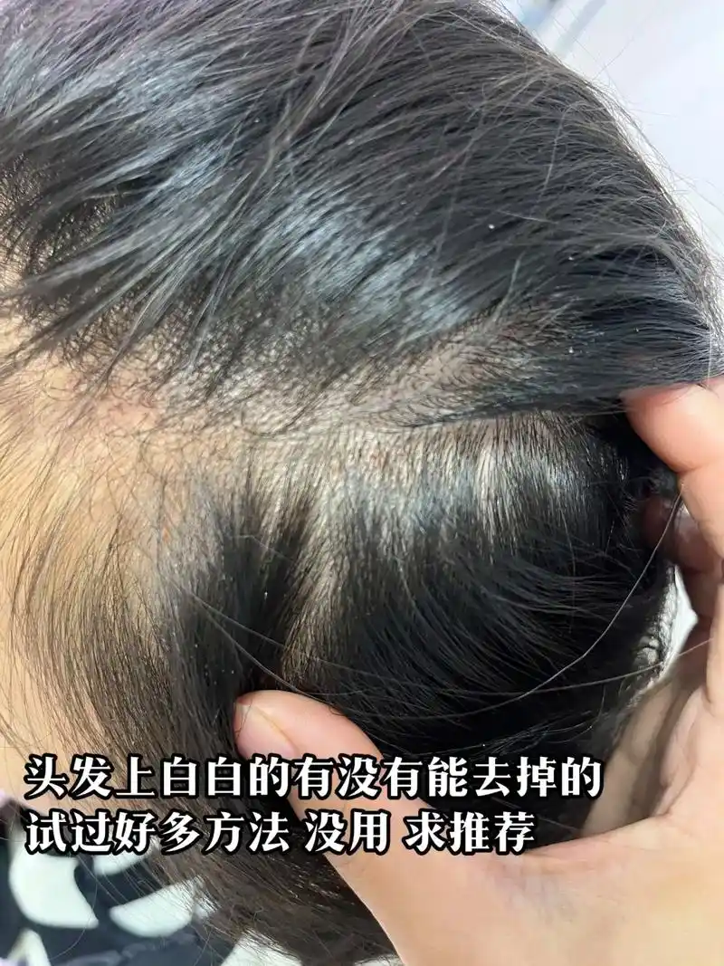 求推荐 去掉头发上白白的 头皮红点点 有时候会痒 痛 - 抖音