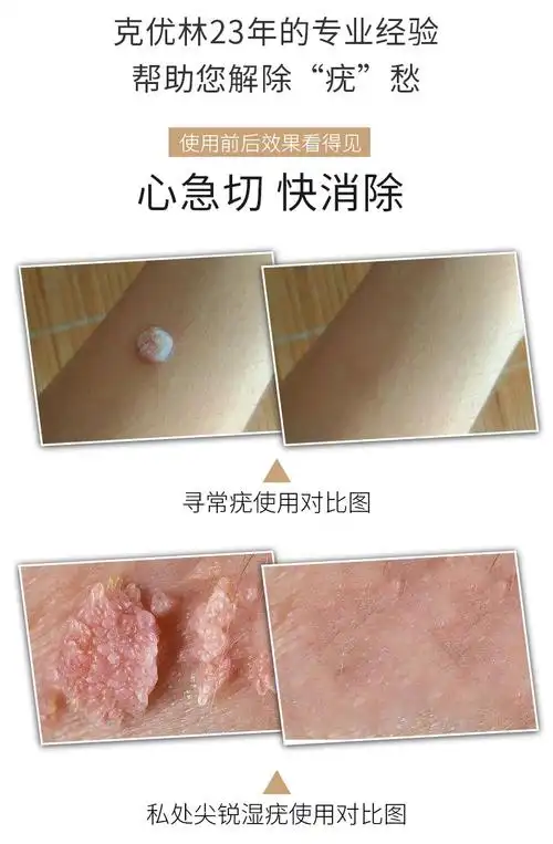 hpv丝状扁平疣去疣液膏沙棘油可炎平qx私处疗程装五代绿瓶3可炎平2
