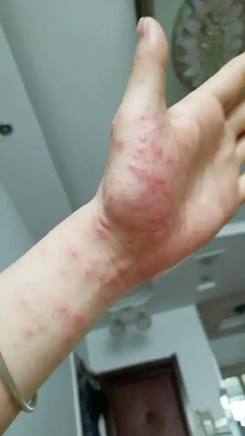 前天吃虾了可能是吃什么过敏吧超级痒现在浑身都是疙瘩