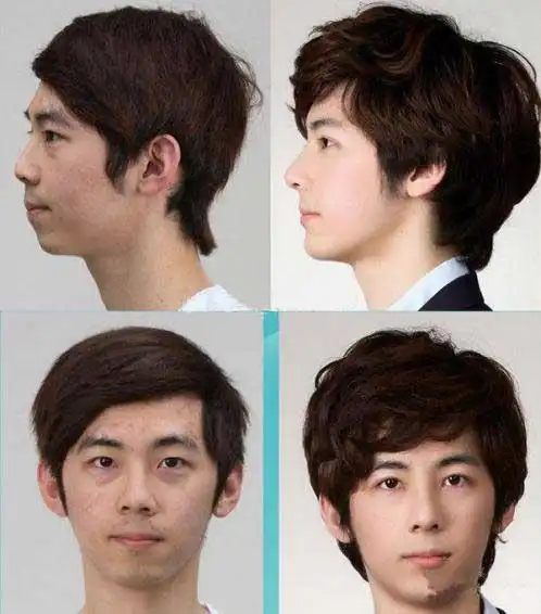 男人整容前后对比照惊艳到爆