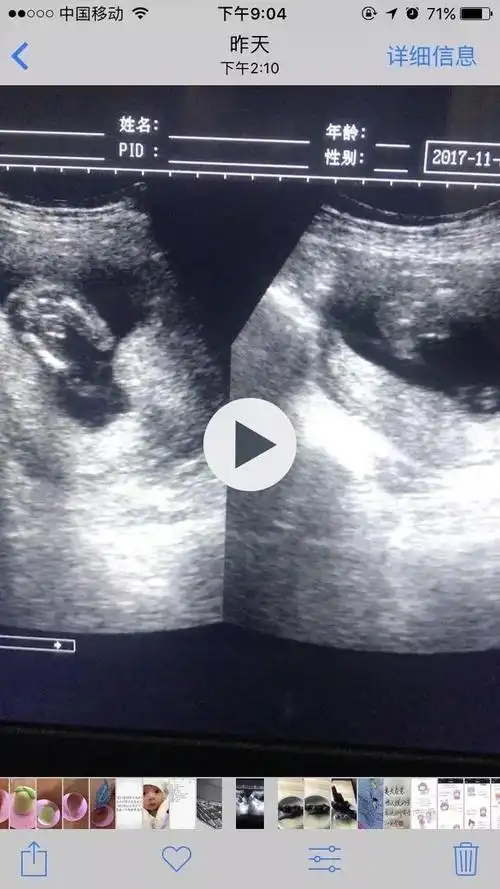 好幸运, 二胎16周就确定是男孩, 分享孕期自己的男宝症状