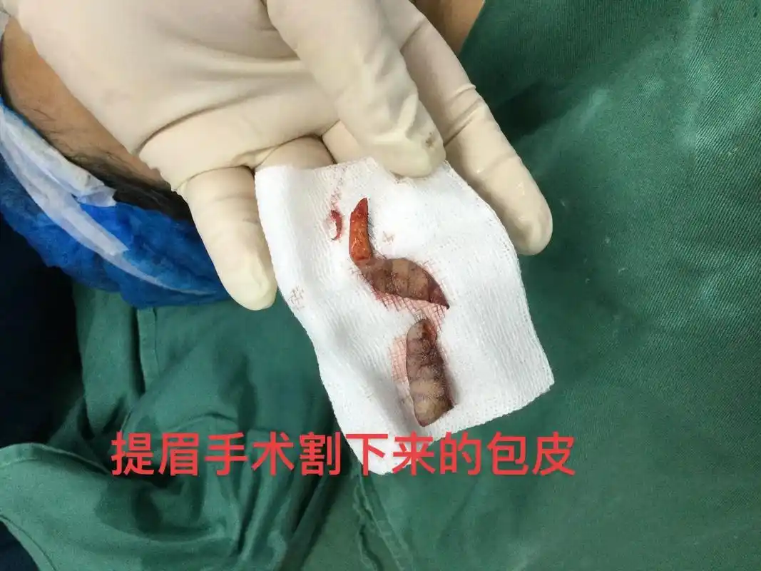 这个提眉当天割下来的包皮,当天前后对比图.
