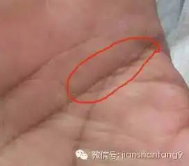 警惕手相里有这样的岛纹说明身体已有疾病