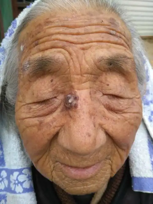 请教医生老年人这种皮肤病还是否需要手术