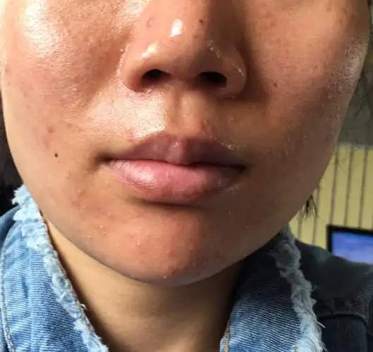 油性痘痘肌红血丝毛孔大皮肤暗沉.还有没有救呀?