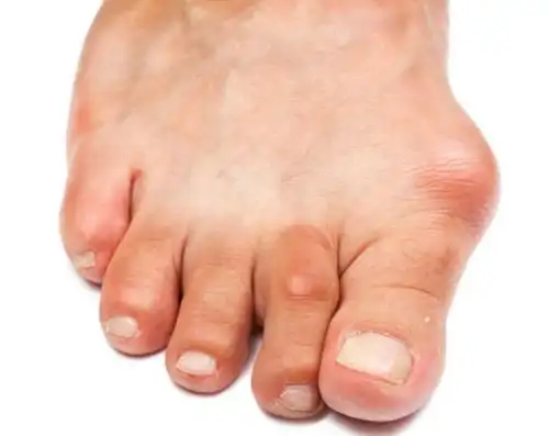 尿酸高472大脚趾红肿热痛是什么引起的武汉疑难杂症专家宋跃进教授需