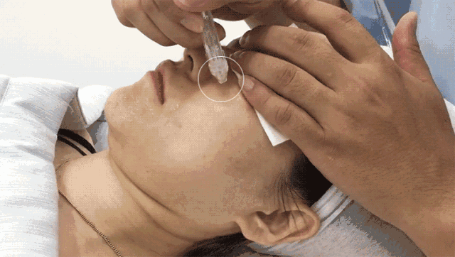 很爽真的有玻尿酸进入到皮肤内层的感觉做完后敷个凉爽舒服的医用面膜