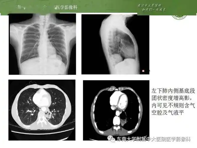 肺隔离症影像表现_郑孝飞