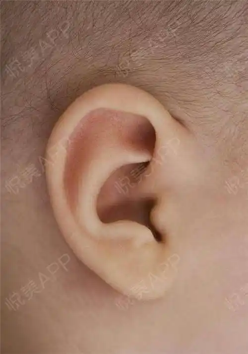 耳轮卷曲畸形矫正