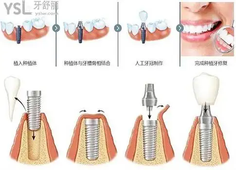 种植牙过程