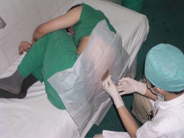 穿刺:用左手固定穿刺点皮肤,右手持穿刺针以垂直背部的方向缓慢刺入