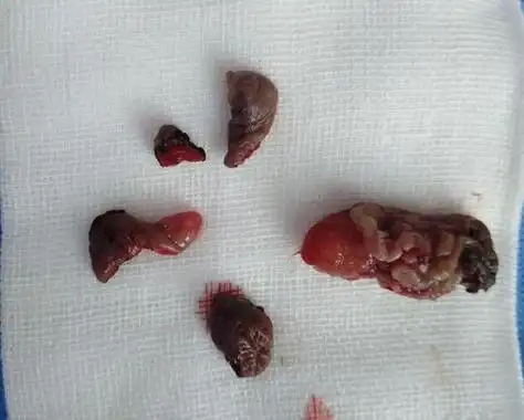 痔疮吻合器环切术半个月左右恢复.