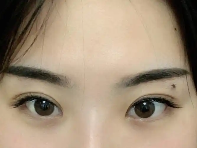 埋线双眼皮第65天