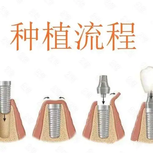 给妈妈最好的礼物:给她种植牙安排上