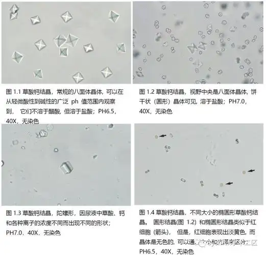 39种尿液结晶形态汇总