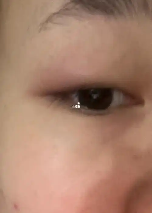 眼睛肿了