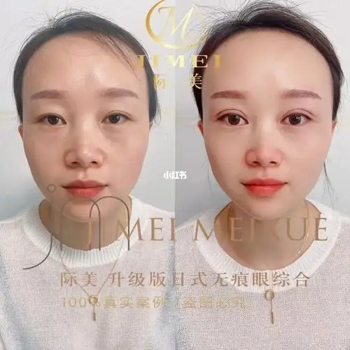 加宽双眼皮修复传统埋线前后对比图90 专属定制,自然无痕,灵动有神.
