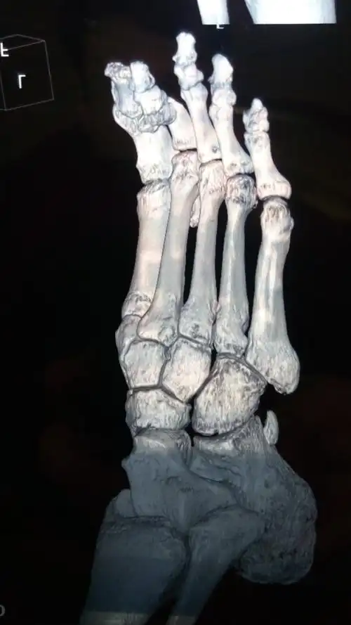 大脚骨手术后多久能恢复