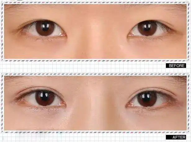 内双到底算不算双眼皮?