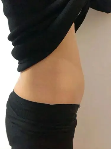 腰腹环吸第八天对比