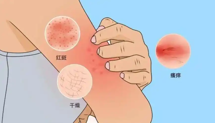 春季过敏高发5个方面预防皮肤瘙痒