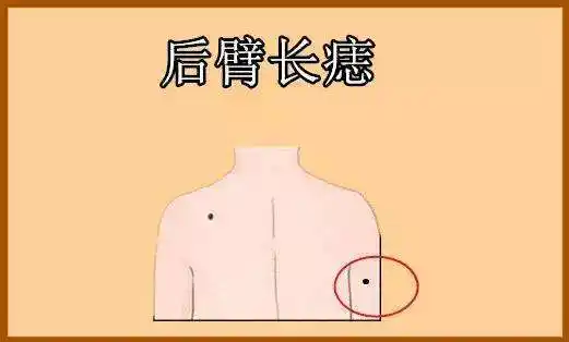 手臂上的痣的位置与命运图解超详细