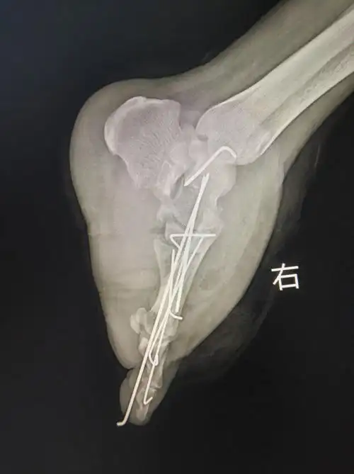 一个足部毁损伤的保肢过程