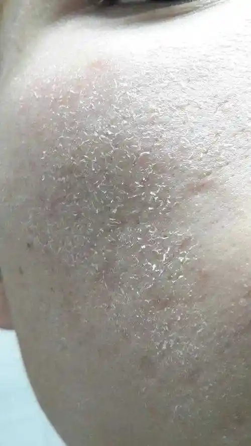 皮肤干燥紧绷怎么办?