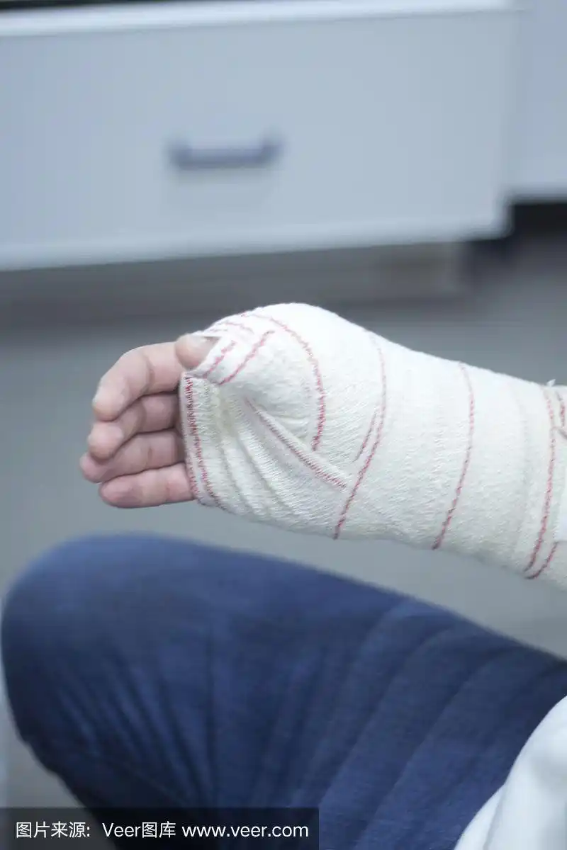 骨折后,医生在患者前臂和手腕上使用石膏石膏和绷带固定.