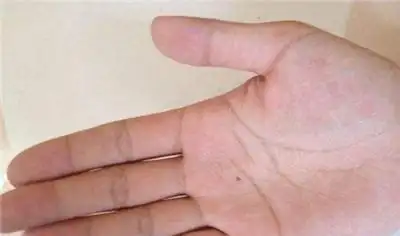 手心有痣的女人:女生右手掌心有一颗痣是什么意思啊?距离生命线很近.
