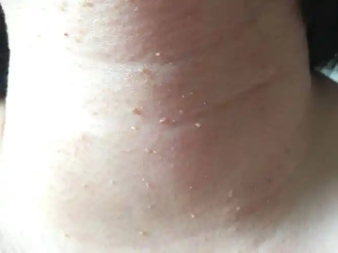 脖子长出小肉粒,不疼也不痒,对身体有伤害吗?看完后就有数了!