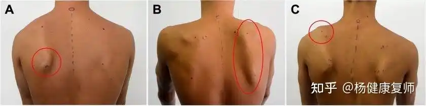 (胸小肌和后侧关节囊的紧张或僵硬)和肌肉失衡(上斜方肌和前锯肌之间)