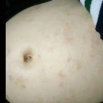 肚子这样像过敏一样好痒好痒 可是只有肚子上有.求解答