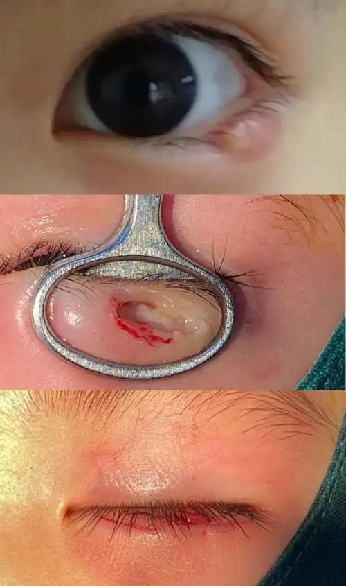 你好,根据你简单的描述,考虑麦粒肿或者散粒肿的可能性大,小的可以