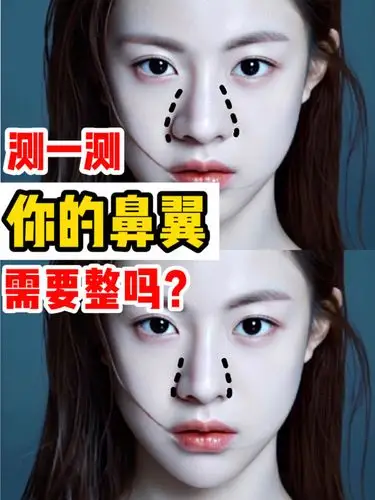 测一测:你的鼻翼算大吗6015你有觉得自己鼻翼大吗?