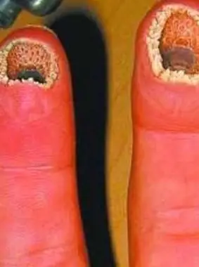 超恶心的手指图片空手指手上全是洞密集症慎入