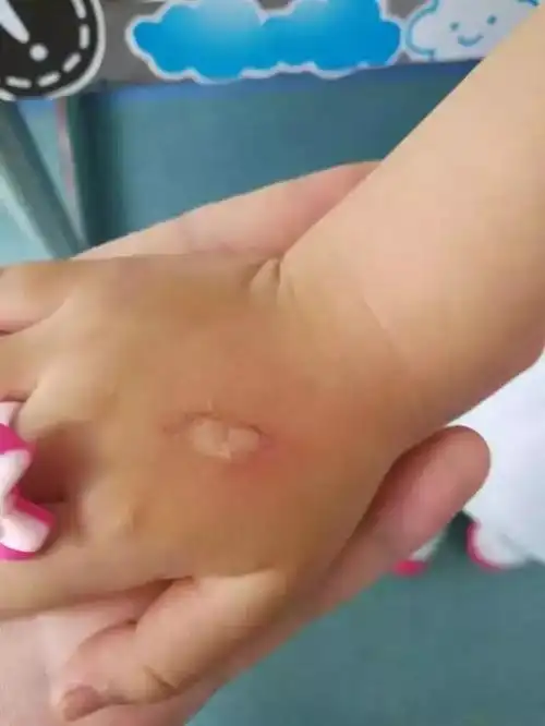 太原3岁女童在北美n1被严重烫伤!商家几番狡辩拒不赔偿