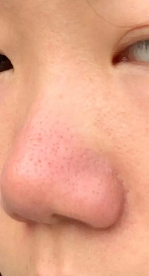 这个鼻子是我永远的痛,不仅鼻子上毛孔大的出奇,而且鼻子的形状也不