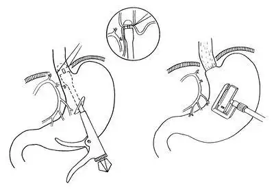 胃肠吻合器的常用术式