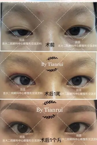 不同程度上睑下垂患者的术前术后对比图片 (原创)