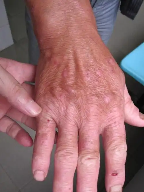 看图识病病例连载之13多形日光疹