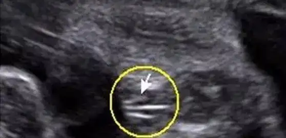 四维彩超看男女这么简单, 学到了