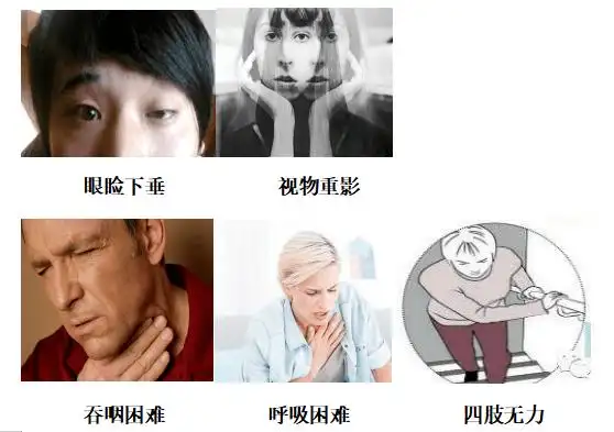 初中女生视力模糊竟然是重症肌无力真想不到