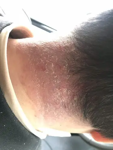 鼻炎治疗症状消失后颈部出现出水泡渗液图