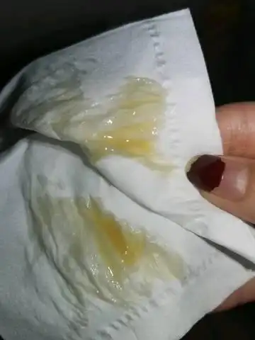 孕八周,刚突然扑通一下跟来姨妈一样,赶紧跑厕所,应该是白带,有点黄