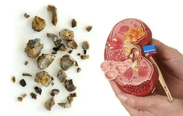 痛风要"肾"重,尿酸性肾结石的这6个早期信号不可不知!_尿液_情况_身体