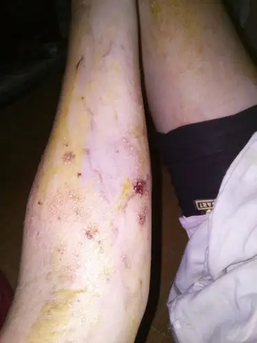 急急 芒果过敏成这样了 求治愈方法!