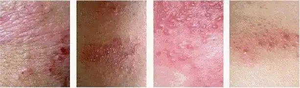 体癣和湿疹的区别,你真的知道了吗?__凤凰网