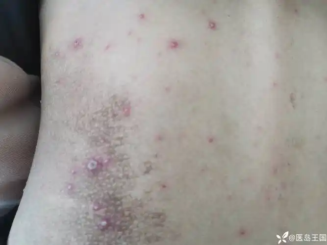 请网上的大佬看看这个皮疹